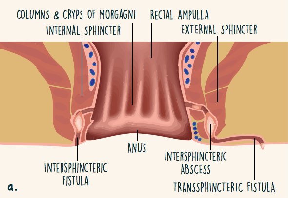 Location of intersphincteric fistula, intersphincteric abscess, and transsphincteric fistula within the ano-rectal anatomy.