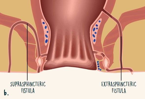 Location of suprasphincteric fistula and extrasphincteric fistula within the ano-rectal anatomy.