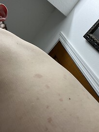 Strange spots on back after taking Biologic meds.