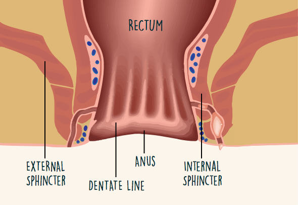 What Is A Fistula And Why Does It Occur With Crohn S Disease