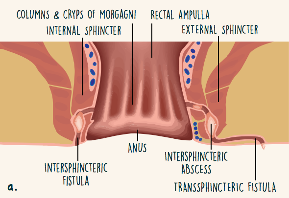 What Is A Fistula And Why Does It Occur With Crohn s or IBD