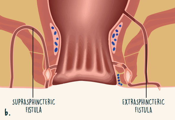 With perianal fistulas