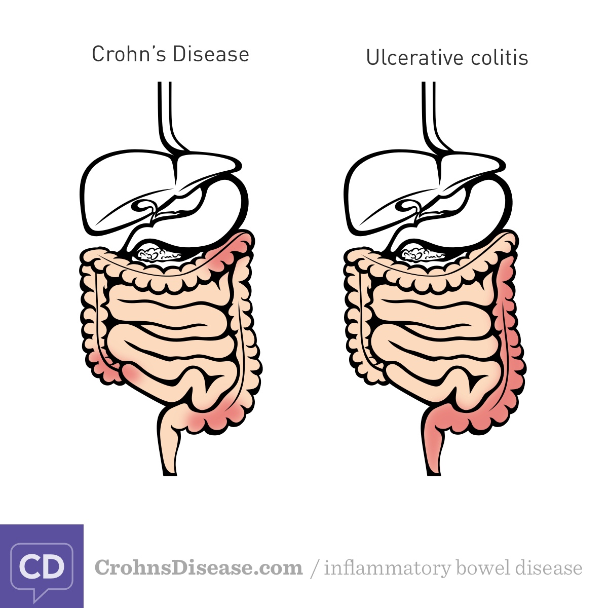 Side by side digestive tracts showing the location of inflammation in Crohn’s disease versus ulcerative colitis.