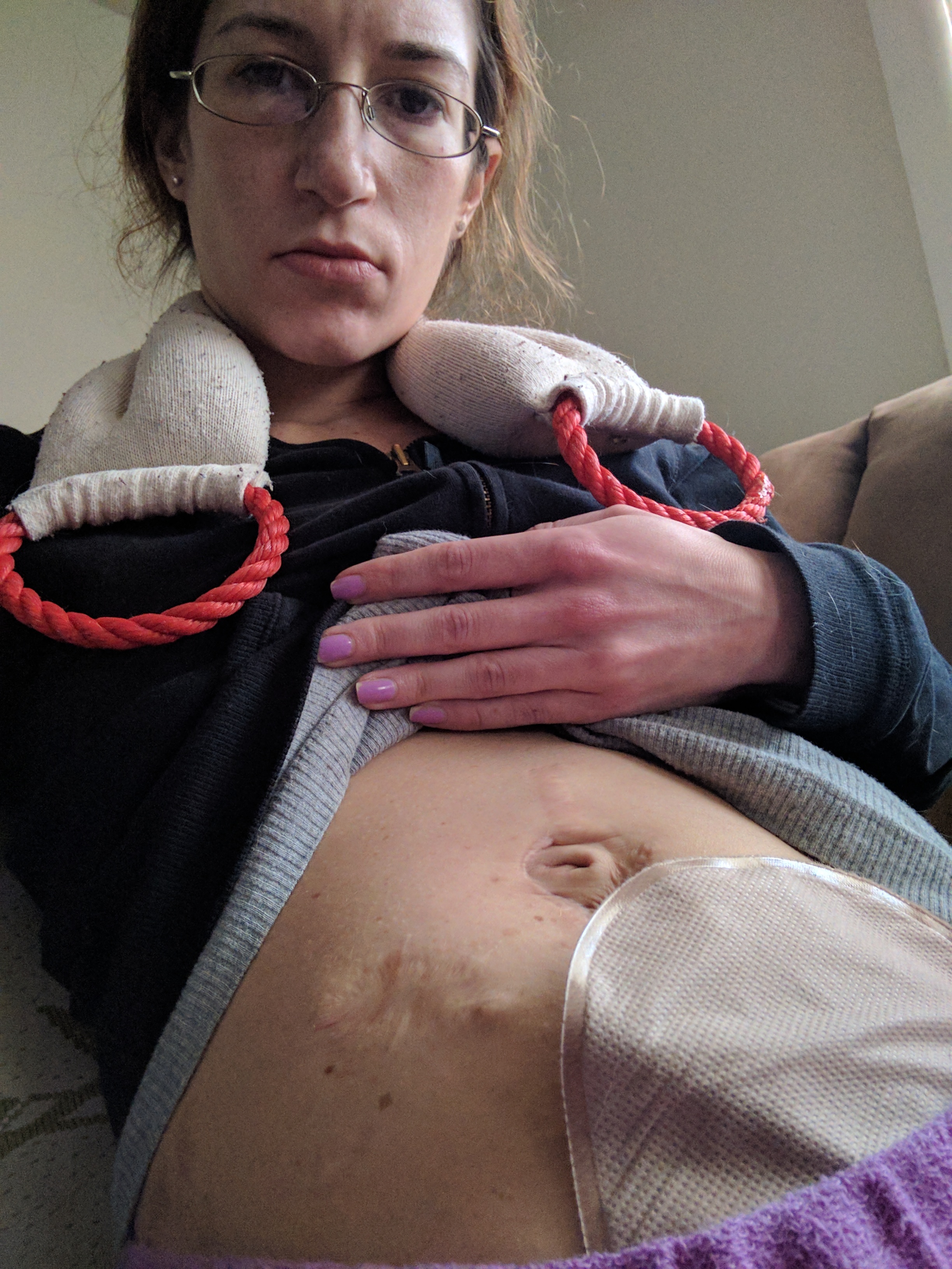 Marisa showing scar and distended stomach from previous surgeries and her permanent ileostomy