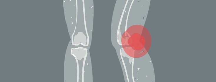 a knee experiencing arthritis and joint pain