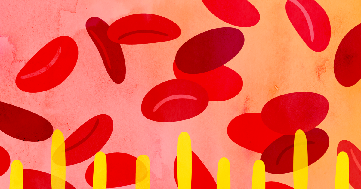 Anemia Complications From Ulcerative Colitis Anemia Complications From Ulcerative Colitis